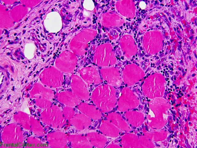 Dermatomyositis, H&E stained section of paraffin embedded muscle x 200